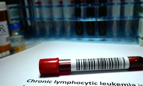 Leucemia linfatica cronica